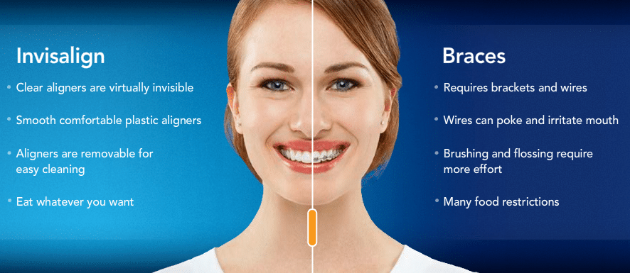 Invisaling vs Traditional Braces pros and cons.