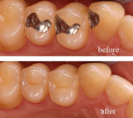 Tooth Colored Fillings Before and After Marietta, GA.