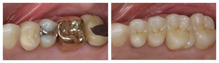 Porcelain crowns before and after photo.