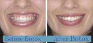 Before and after gummy smile, botox treatment Marietta, GA.