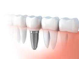 Dental implant in jaw illustration.