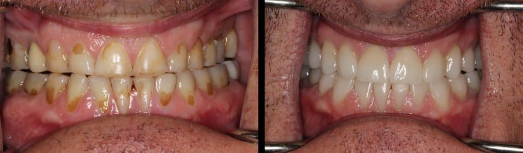 Photo of full mouth before and after same day smile makeovers treatment Marietta, GA.