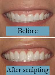 Photos of before and after gum reshaping procedure Marietta, GA.