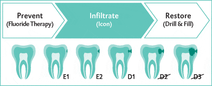 Three steps of how cavities advance: prevent (fluoride therapy) - infiltrate - restore (drill & fill tooth).