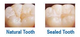 Dental sealants treatment - before and after photos. Natural vs sealed tooth.