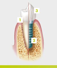 Illustration showing the differene between tooh and tooth implant.