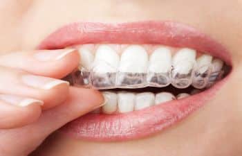 Marietta GA Invisible Braces for Adults and Teens