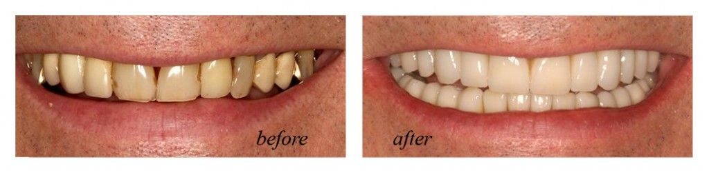 Full mouth reconstruction before and after photo.