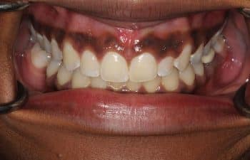 Patient's teeth after Invisalign treatment.