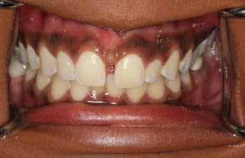 Patient's teeth before Invisalign treatment.