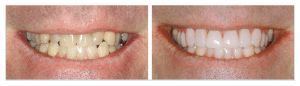 Porcelain veneers before and after photo.