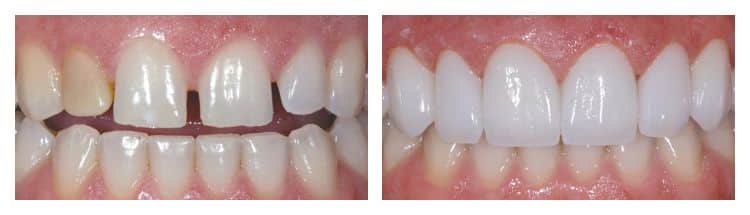 Porcelain veneers before and after photo.