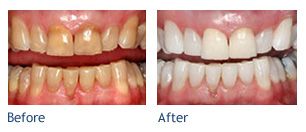 Teeth whitening before and after photo.