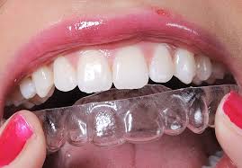 Clear aligners.