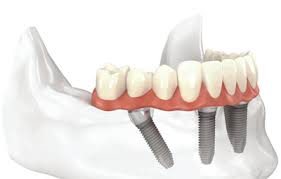 All-on-4 dentures illustration. Marietta, GA.