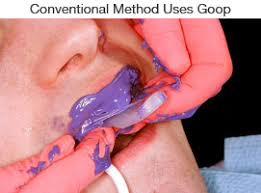 Dental impressions. Conventional Method Uses Goop.
