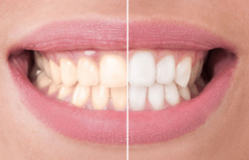 Tooth Colored Restoration in Marietta