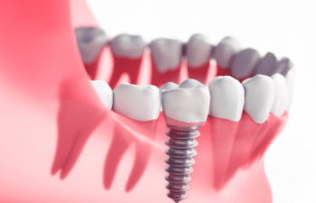 Dental implant illustration showing a screw-in implant among natural teeth in pink gum tissue.