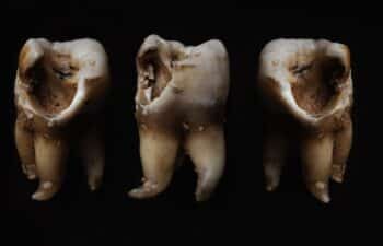 Our Marietta dentist takes care tooth decay in Marietta's patients