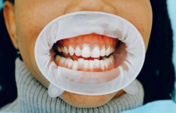 Full mouth reconstruction showing white dental crowns and restored teeth alignment.
