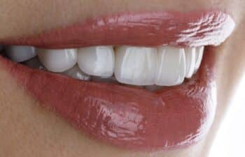 Porcelain vs Zirconia