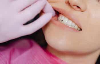 Crossbite treatment by Gilreath dentistry Marietta