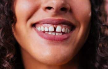 Diastema Treatment by Gilreath family Dentistry Marietta