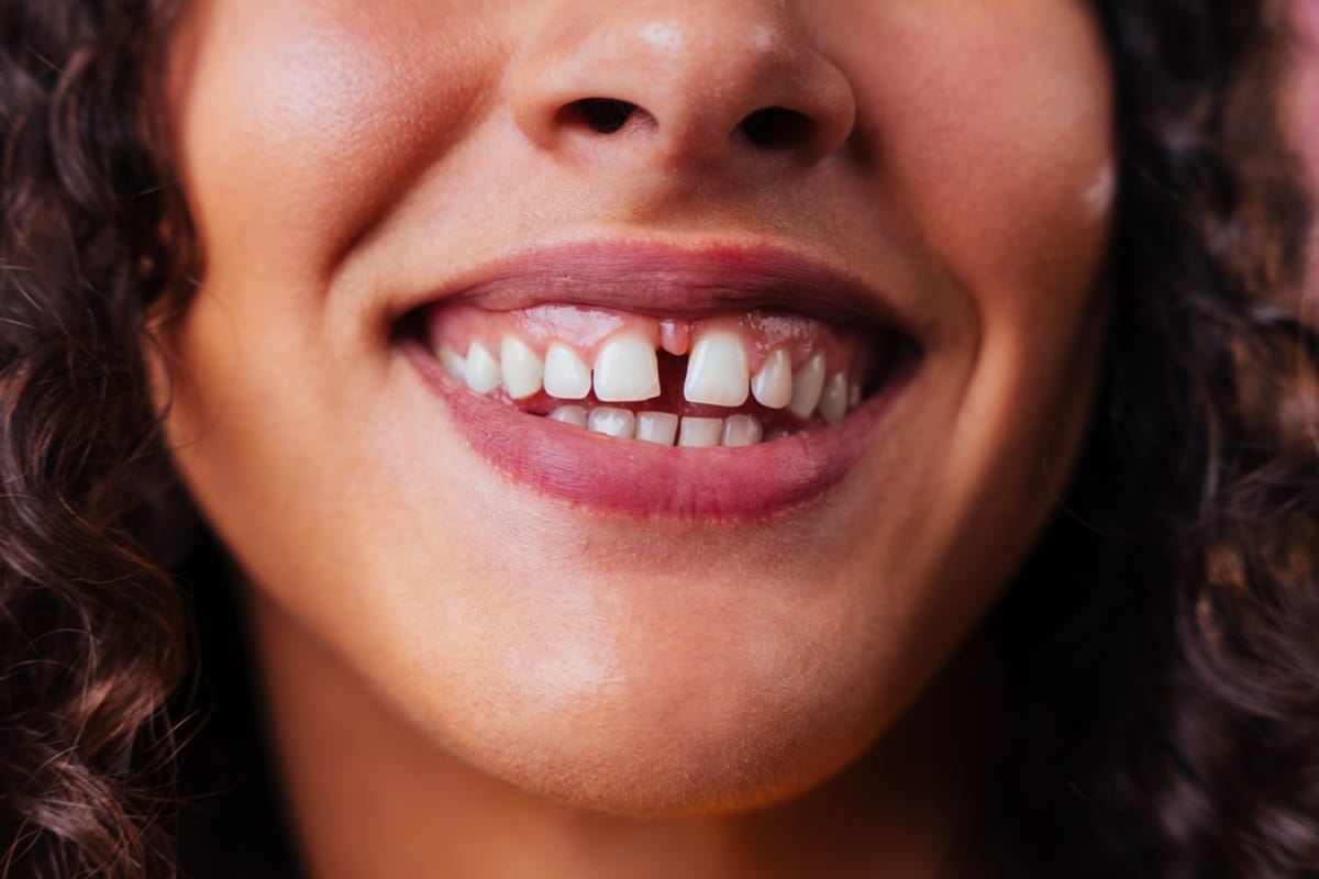 Diastema-Treatment-by-Gilraeth