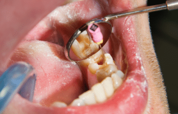 Root Canal Infection treatment by Gilreath Family Dentistry Marietta