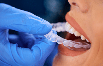 Invisalign
