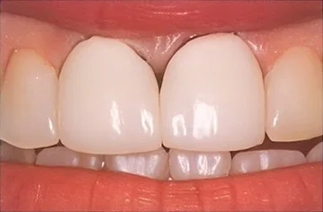 Front teeth before same-day crown treatment.