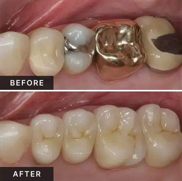 Back teeth before and after same-day crowns replacing older dental restorations.