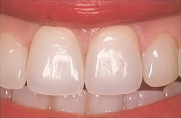 Front teeth after same-day crown treatment.